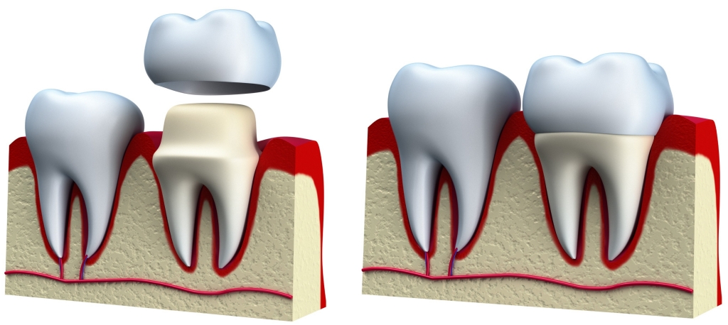 Dental Crowns Coral Springs FL