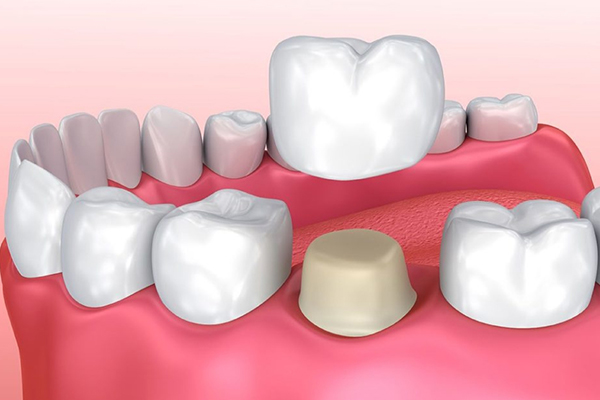 Dental Crowns Coral Springs FL