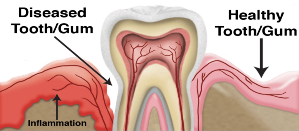 Gum Disease Dentist Coral Springs FL